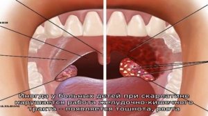 Налет на гландах и  миндалинах у ребенка