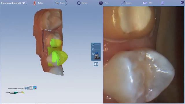 Planmeca Emerald Restorative Scanning 720p смотреть онлайн