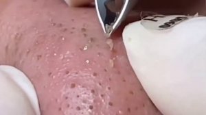 ✅ Чистка пор и выдавливание прыщей #30