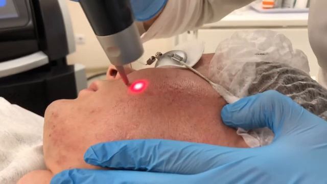 Лечение рубцов постакне на пикосекундном лазере PicoSure смотреть онлайн