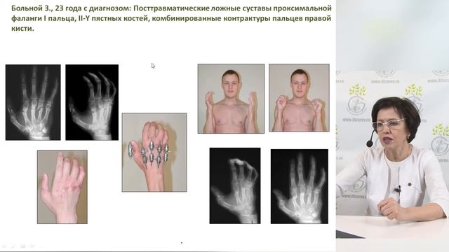 Лечение больных с посттравматическими деформациями кисти с применением метода Илизарова. смотреть онлайн