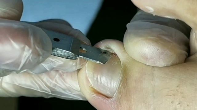 Chinese professional pedicure/tickle feet/Ingrown/nails/레 푸스/#Ingrown #Pedicure #toenails 81【ASMR】 смотреть онлайн