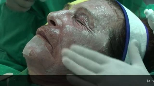 PEELING PROFUNDO CON FENOL | PHENOL PEELING (english Subtitles) - EL REJUVENECIMIENTO EXTREMO