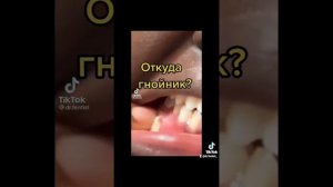 Гнойный свищ! Откуда? И что делать!