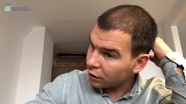 Пересадка волос в Турции. Отчет 6 месяцев после пересадки волос. Minoxidil4you пересадка волос смотреть онлайн
