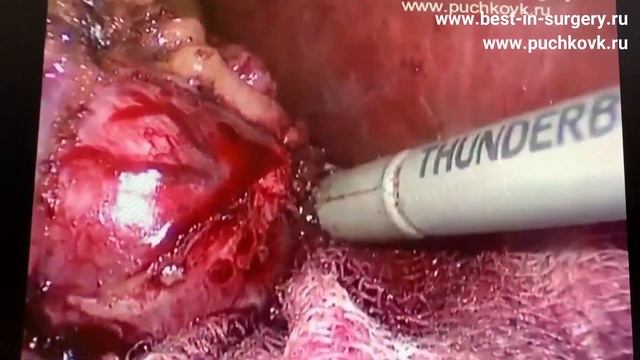 Лапароскопическая резекция почки с ишемией ZERO смотреть онлайн