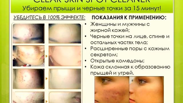 Spot Cleaner - вакуумная чистка лица от интернет магазина chistye-pory.ru смотреть онлайн