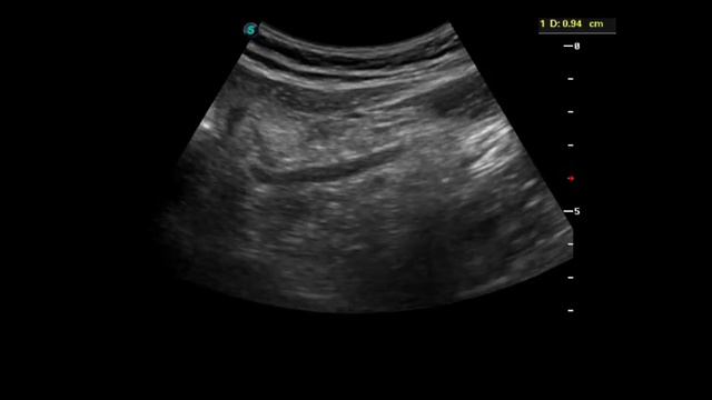 Острый флегмонозный аппендицит у меня, самодиагностика смотреть онлайн