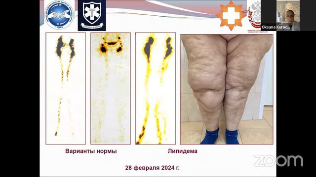 Вебинар. Важность диагностических исследований в лечении лимфедемы верхних и нижних конечностей. смотреть онлайн