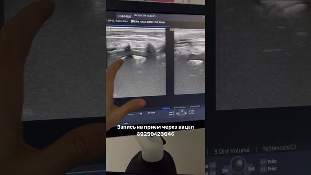 Узи сосудов шеи и головы. Атеросклероз лечение. Как проверить сосуды? Флеболог Москва смотреть онлайн