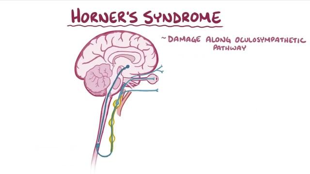 Horner's syndrome - causes, symptoms, diagnosis, treatment, pathology смотреть онлайн
