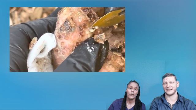 PODIATRISTS REACT To JIGGER EXCISION