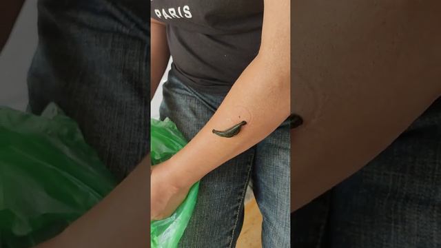 Остеоартроз верхних конечностей кистей рук смотреть онлайн