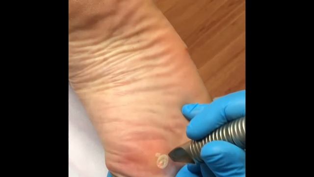 Удаление подошвенных бородавок лазером смотреть онлайн