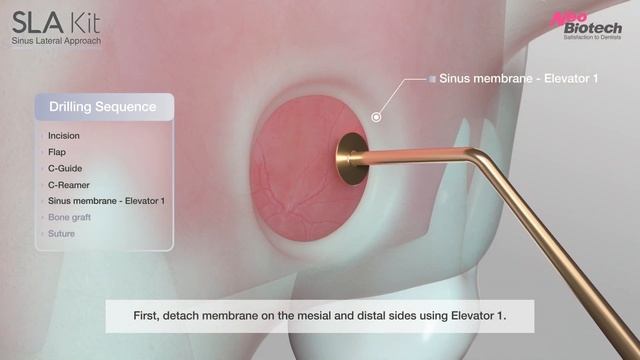 NeoBiotech SLA (Sinus Lateral Approach) Kit Overview смотреть онлайн