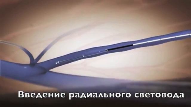 Лазерное лечение варикоза (ЭВЛК) с использованием радиальных световодов смотреть онлайн