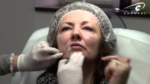 Губоподбородочная линия и ее коррекция