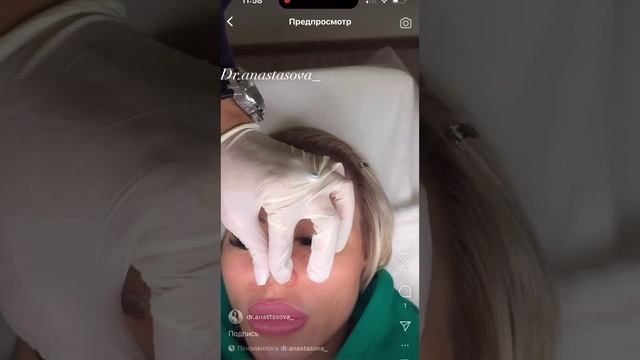 Сужение носа дипроспаном смотреть онлайн