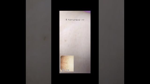 #электроэпиляция смотреть онлайн