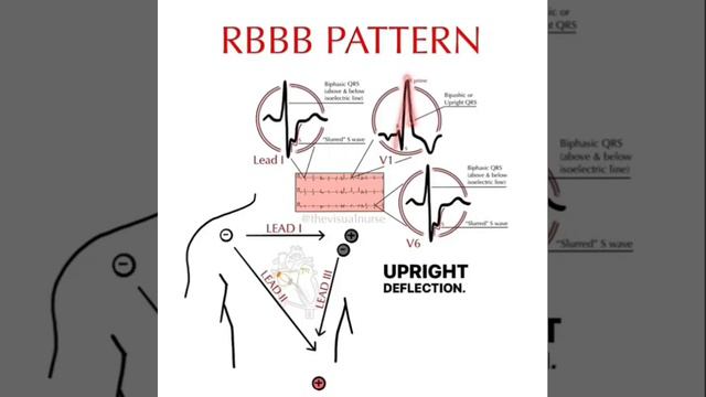 RBBB смотреть онлайн