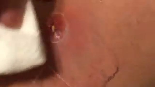 Spider Bite or MRSA? Day 10 смотреть онлайн