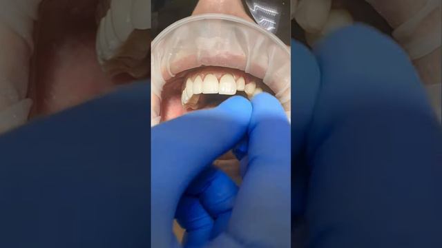 Примерка виниров #виниры смотреть онлайн