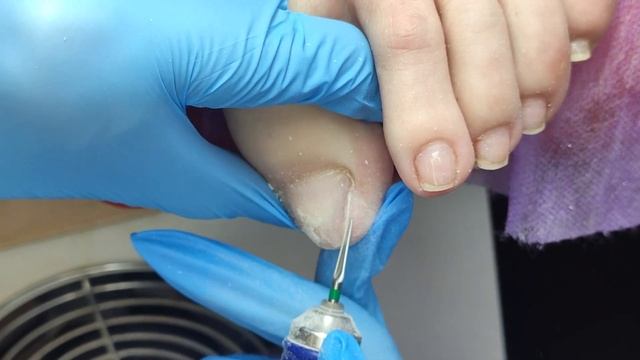 СНОВА ОНИХОЛИЗИС. 2 ЧАСТЬ. ПРОТЕЗИРОВАТЬ ОНИХОЛИЗИС ИЛИ НЕТ? ТРАВМА НОГТЯ. NAILS 修腳 , 腳趾甲 , 修指甲 смотреть онлайн