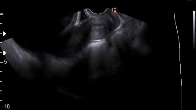 Киста яичника больших размеров + беременность раннего срока( 21-9-17) смотреть онлайн