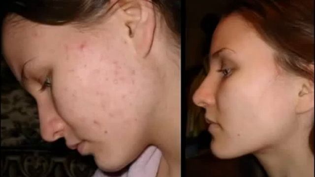 Фото До и После похудения. Фото людей, которым удалось похудеть смотреть онлайн