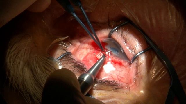 Хирургическое лечение глаукомы смотреть онлайн