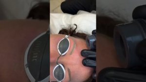 Удаление татуажа бровей лазером в прямом эфире #удалениетатуажа