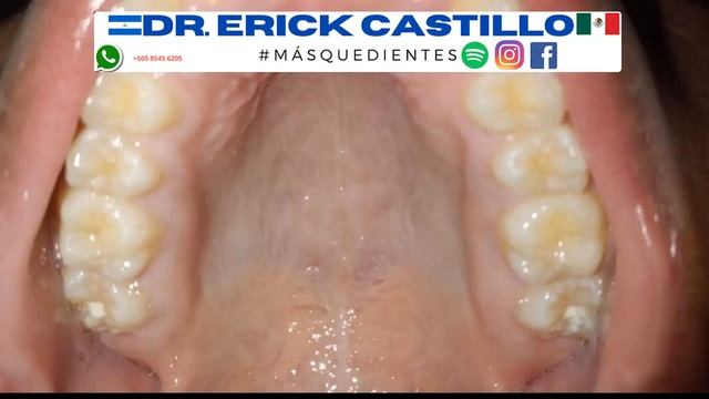 Mira este paladar ¿te ha pasado algo similar? смотреть онлайн