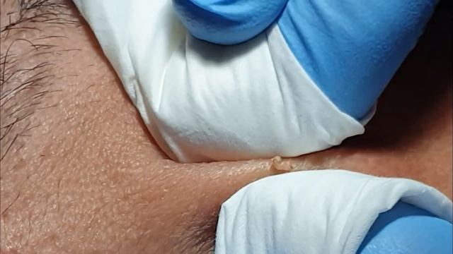 BLACKHEADS EXTRACTIONS  On  Happy's Forehead #3