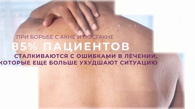 Лечение акне на аппарате Deka Luxea смотреть онлайн