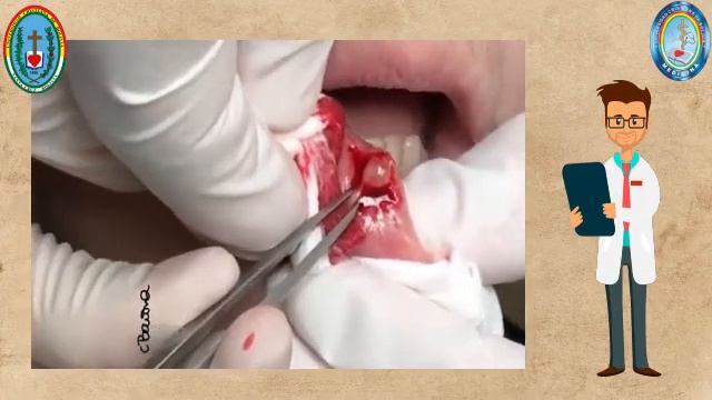 TUMOR ADENOMA PLEOMORFO смотреть онлайн