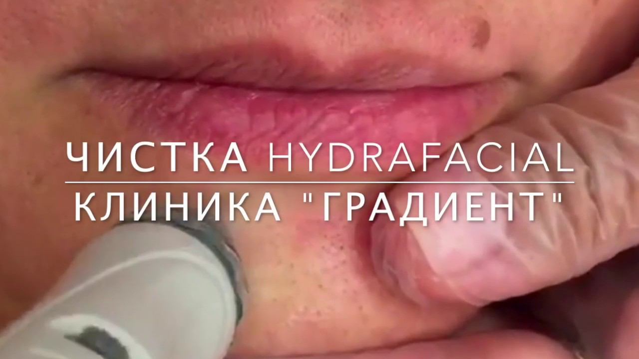 HYDRAFACIAL - вакуумная чистка лица смотреть онлайн