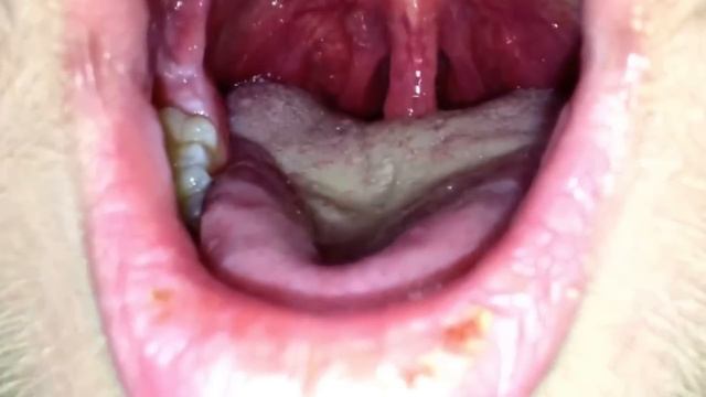 Quinckes Disease - Medical Minute