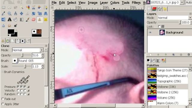 On The Cleaning Of Wounds #GIMP