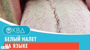 ? Белый налет на языке. Клинический случай №386