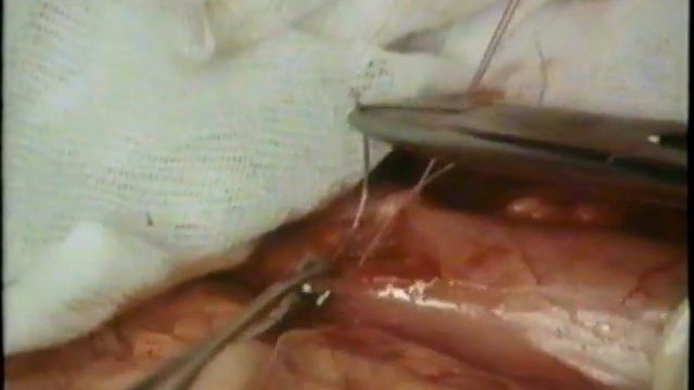 Рак желудка, академик Н.Н.Трапезников © Surgical treatment of cancer смотреть онлайн