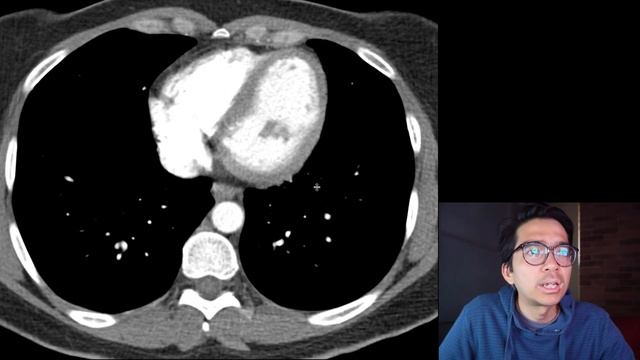 Classic Case: Sarcoid смотреть онлайн