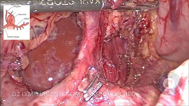 Laparoscopic Distal Subtotal Gastrectomy, D2 lymph node dissection, Laparoscopic D2 gastrectomy. смотреть онлайн