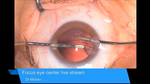 Lentis Comfort EDOF Lukan Mishev Live Stream смотреть онлайн