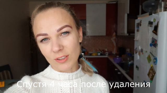 Удаление татуажа бровей. ЛАЗЕР vs РЕМУВЕР. смотреть онлайн