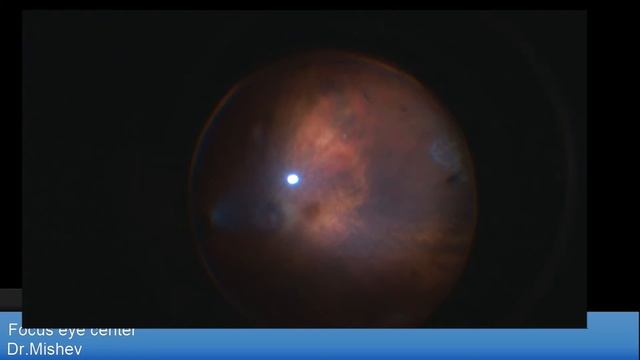 Retinal detachment with MplusX multifocal IOL , Oxane 5700 removal Lukan Mishev Live Stream смотреть онлайн