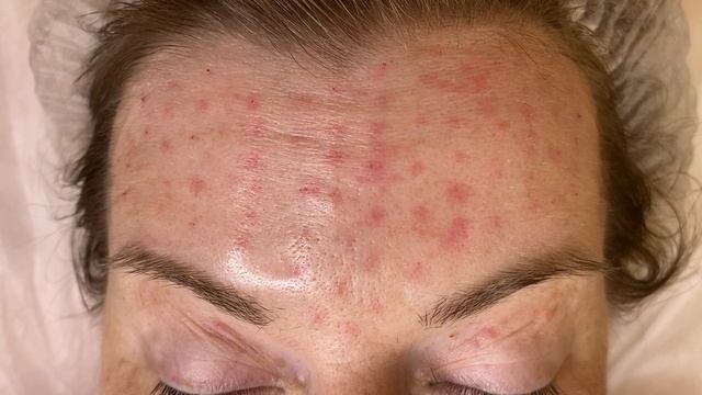 Ботокс лба смотреть онлайн