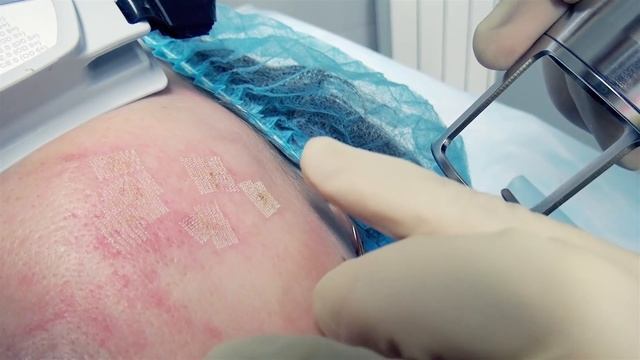 Лазерная шлифовка рубцов смотреть онлайн