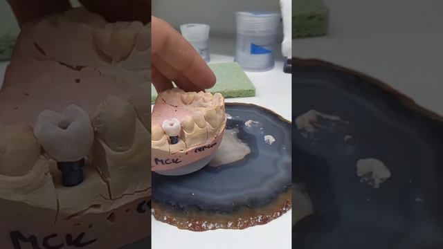 Коронка циркон на импланте смотреть онлайн