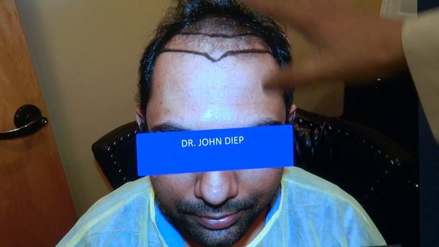 MEN HAIR LOSS TREATMENT: ART OF HAIR TRANSPLANT RESTORATION SURGERY 1- YEAR FOLLOW-UP смотреть онлайн