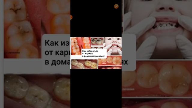 Как избавиться от кариеса в домашних условиях смотреть онлайн